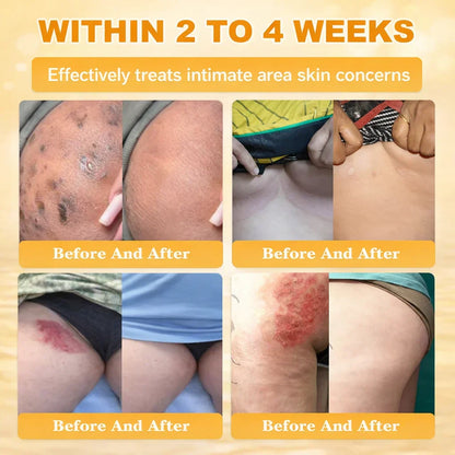 【𝐿𝑎𝑠𝑡 𝐷𝑎𝑦 𝑃𝑟𝑜𝑚𝑜𝑡𝑖𝑜𝑛 70% 𝑂𝐹𝐹】𝒀𝑰𝑻𝑶𝑾𝑨𝒀™ 𝑇𝑎𝑙𝑙𝑜𝑤 & 𝐵𝑒𝑒 𝑉𝑒𝑛𝑜𝑚 𝑅𝑒𝑝𝑎𝑖𝑟 𝐶𝑟𝑒𝑎𝑚（for acne, wrinkles, and damaged skin — steroid-free）