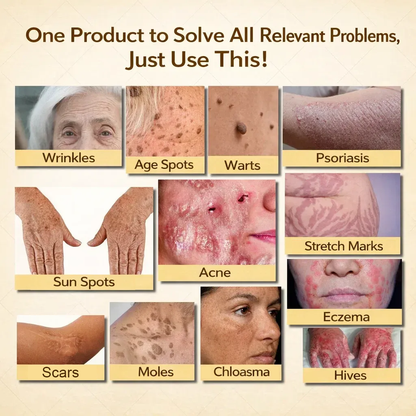 【𝐿𝑎𝑠𝑡 𝐷𝑎𝑦 𝑃𝑟𝑜𝑚𝑜𝑡𝑖𝑜𝑛 70% 𝑂𝐹𝐹】𝒀𝑰𝑻𝑶𝑾𝑨𝒀™ 𝑇𝑎𝑙𝑙𝑜𝑤 & 𝐵𝑒𝑒 𝑉𝑒𝑛𝑜𝑚 𝑅𝑒𝑝𝑎𝑖𝑟 𝐶𝑟𝑒𝑎𝑚（for acne, wrinkles, and damaged skin — steroid-free）