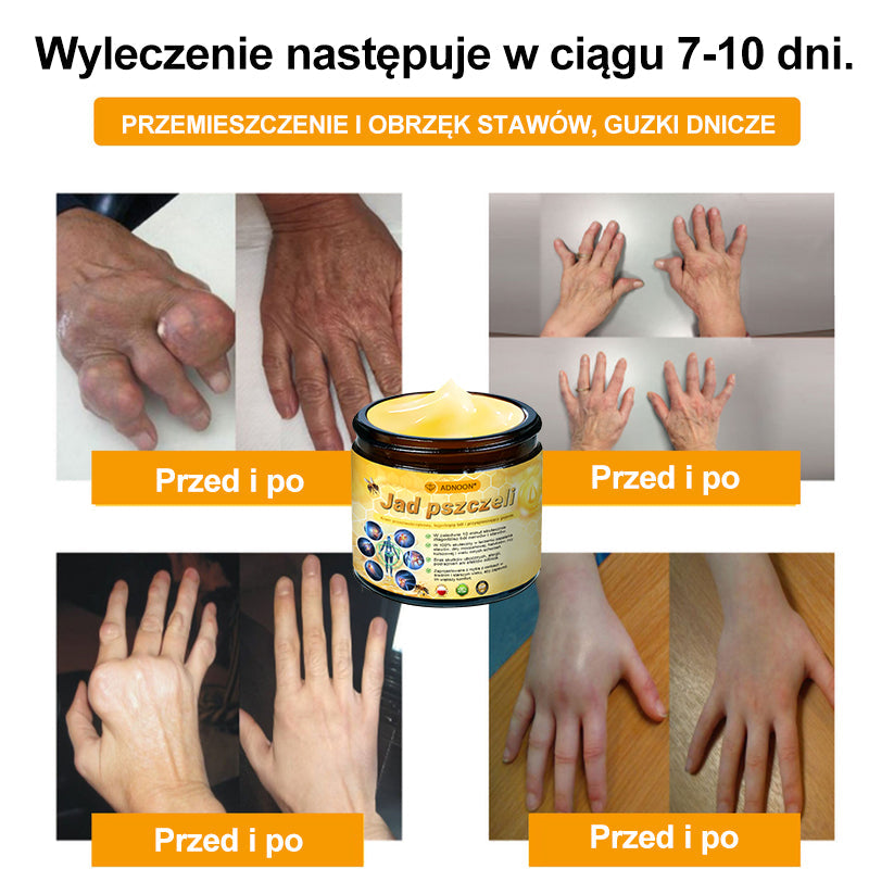 ADNOON® Krem Przeciwobrzękowy i Przeciwbólowy z Jadem Pszczelim