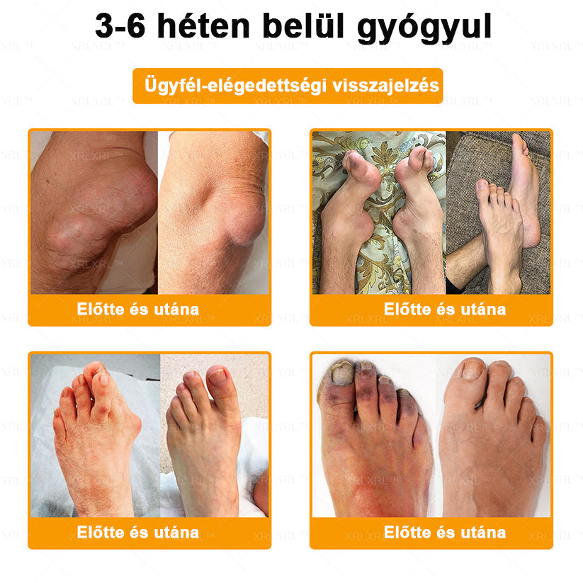 𝑿𝑹𝑳𝑿𝑹𝑳®🧑‍⚕️ Botulinum Toxin és Méhméreg Fájdalomcsillapító Csontgyógyító Krém (Felnőttek és idősek számára)