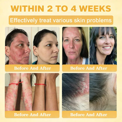 【𝐿𝑎𝑠𝑡 𝐷𝑎𝑦 𝑃𝑟𝑜𝑚𝑜𝑡𝑖𝑜𝑛 70% 𝑂𝐹𝐹】𝒀𝑰𝑻𝑶𝑾𝑨𝒀™ 𝑇𝑎𝑙𝑙𝑜𝑤 & 𝐵𝑒𝑒 𝑉𝑒𝑛𝑜𝑚 𝑅𝑒𝑝𝑎𝑖𝑟 𝐶𝑟𝑒𝑎𝑚（for acne, wrinkles, and damaged skin — steroid-free）