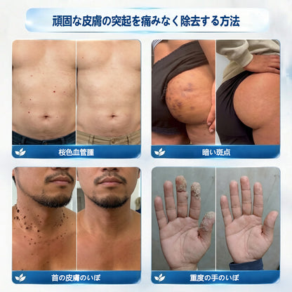 公式ストア🎉7 日間ピンポイントケアローラー 痛みなし・傷跡残らないタイプ