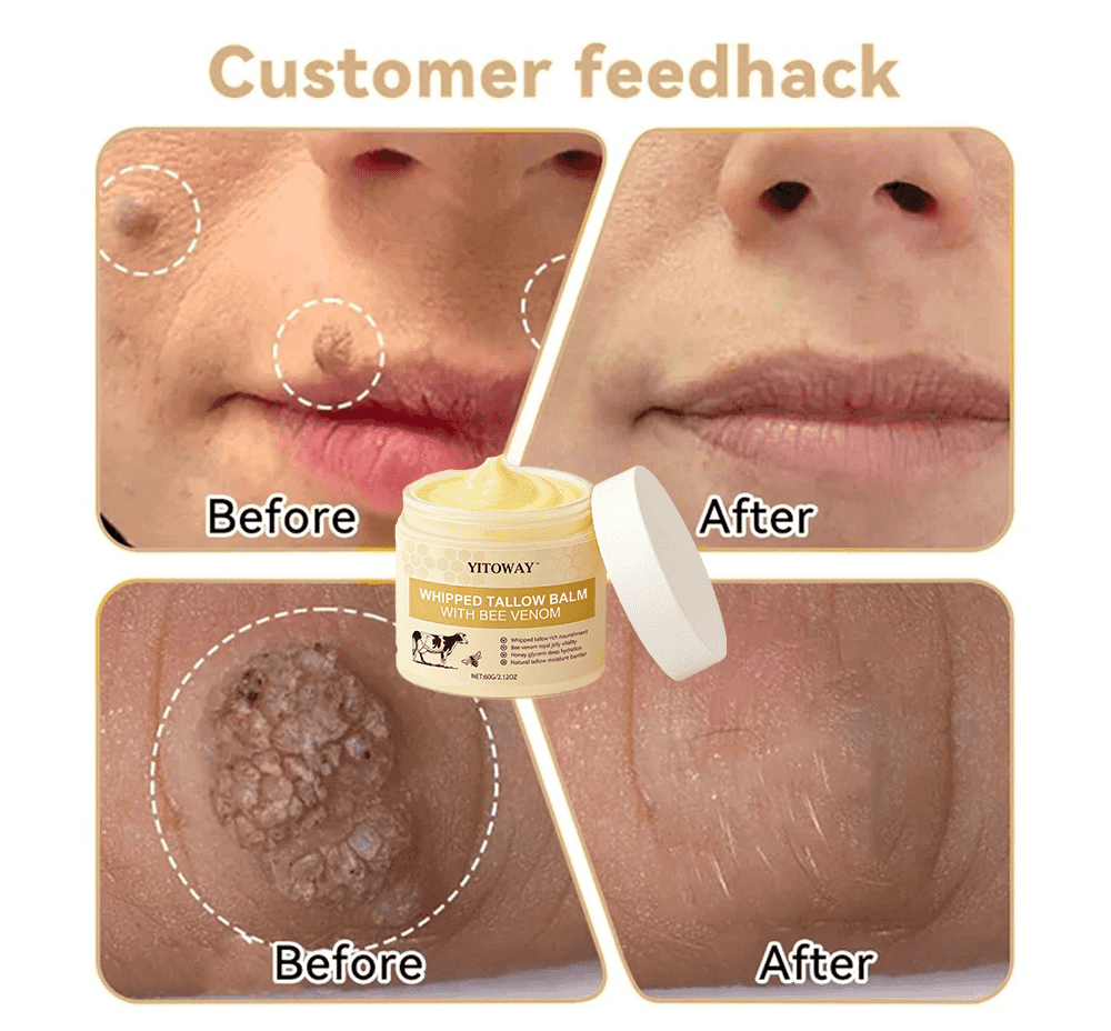 【𝐿𝑎𝑠𝑡 𝐷𝑎𝑦 𝑃𝑟𝑜𝑚𝑜𝑡𝑖𝑜𝑛 70% 𝑂𝐹𝐹】𝒀𝑰𝑻𝑶𝑾𝑨𝒀™ 𝑇𝑎𝑙𝑙𝑜𝑤 & 𝐵𝑒𝑒 𝑉𝑒𝑛𝑜𝑚 𝑅𝑒𝑝𝑎𝑖𝑟 𝐶𝑟𝑒𝑎𝑚（for acne, wrinkles, and damaged skin — steroid-free）