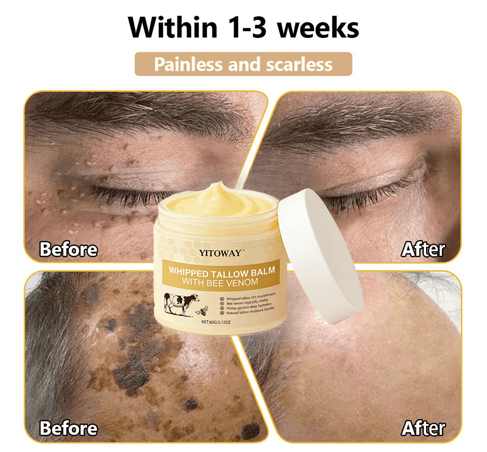 【𝐿𝑎𝑠𝑡 𝐷𝑎𝑦 𝑃𝑟𝑜𝑚𝑜𝑡𝑖𝑜𝑛 70% 𝑂𝐹𝐹】𝒀𝑰𝑻𝑶𝑾𝑨𝒀™ 𝑇𝑎𝑙𝑙𝑜𝑤 & 𝐵𝑒𝑒 𝑉𝑒𝑛𝑜𝑚 𝑅𝑒𝑝𝑎𝑖𝑟 𝐶𝑟𝑒𝑎𝑚（for acne, wrinkles, and damaged skin — steroid-free）