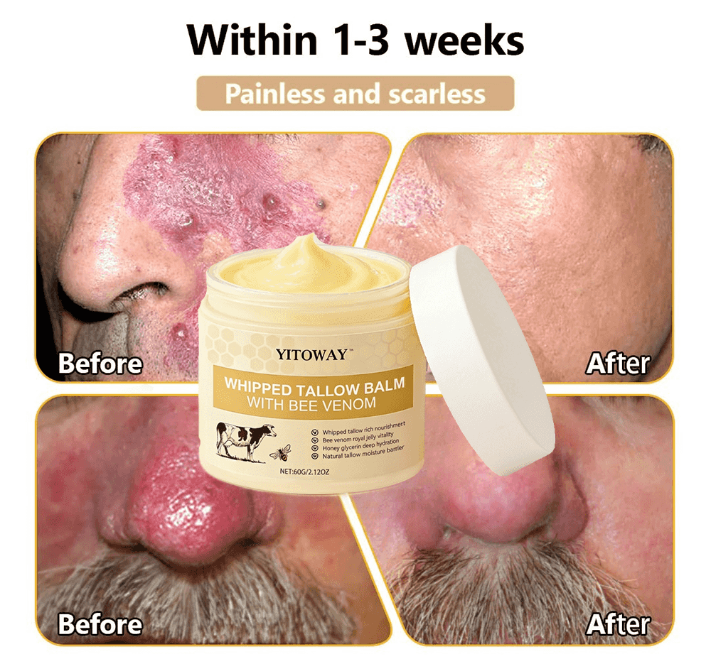 【𝐿𝑎𝑠𝑡 𝐷𝑎𝑦 𝑃𝑟𝑜𝑚𝑜𝑡𝑖𝑜𝑛 70% 𝑂𝐹𝐹】𝒀𝑰𝑻𝑶𝑾𝑨𝒀™ 𝑇𝑎𝑙𝑙𝑜𝑤 & 𝐵𝑒𝑒 𝑉𝑒𝑛𝑜𝑚 𝑅𝑒𝑝𝑎𝑖𝑟 𝐶𝑟𝑒𝑎𝑚（for acne, wrinkles, and damaged skin — steroid-free）