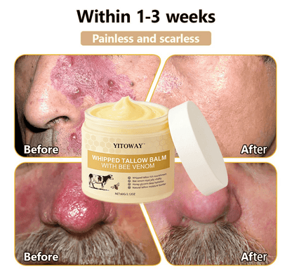 【𝐿𝑎𝑠𝑡 𝐷𝑎𝑦 𝑃𝑟𝑜𝑚𝑜𝑡𝑖𝑜𝑛 70% 𝑂𝐹𝐹】𝒀𝑰𝑻𝑶𝑾𝑨𝒀™ 𝑇𝑎𝑙𝑙𝑜𝑤 & 𝐵𝑒𝑒 𝑉𝑒𝑛𝑜𝑚 𝑅𝑒𝑝𝑎𝑖𝑟 𝐶𝑟𝑒𝑎𝑚（for acne, wrinkles, and damaged skin — steroid-free）