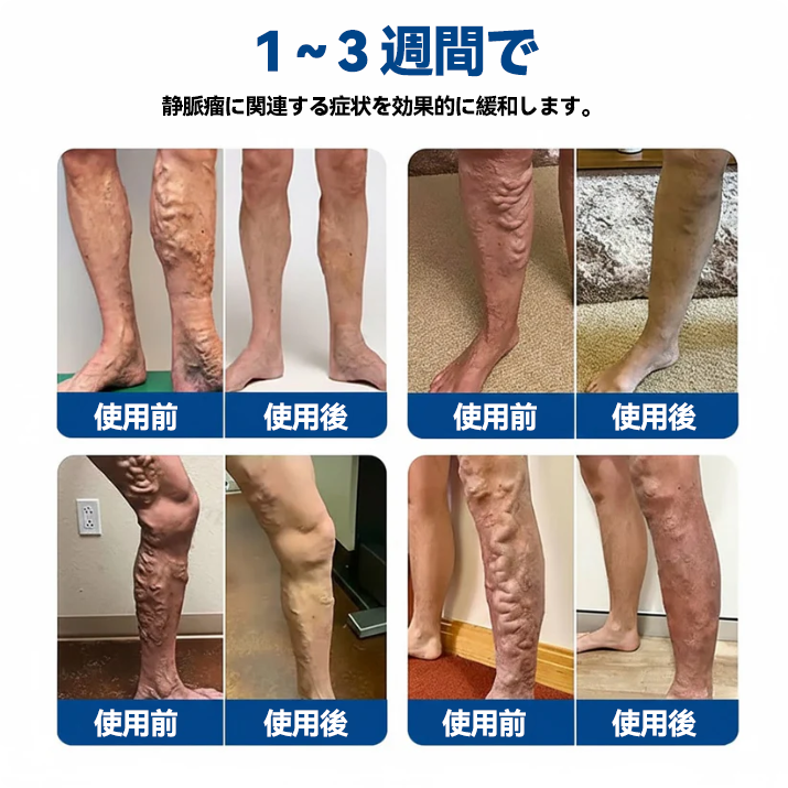 🇯🇵👨‍⚕️✅TAILEDEN® VeinEase マイクロニードルパッチ⚡すぐに実感、長く続く効果